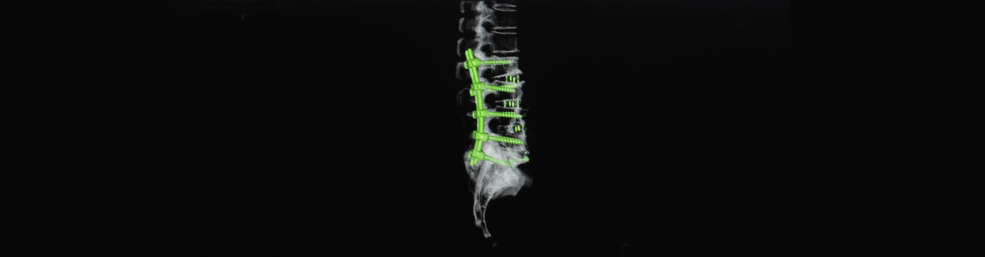 Computer tomography or CT scan image of spine showing pedicle screw fixation