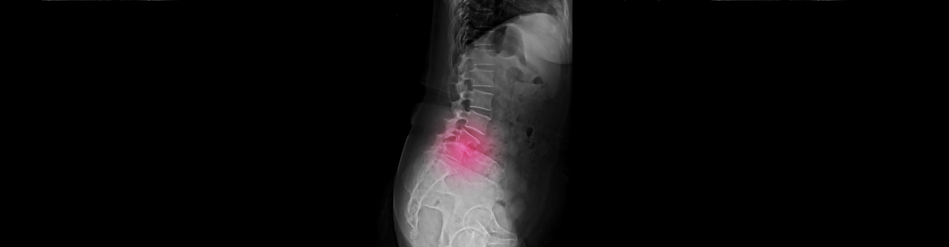 a lateral x-ray of lumbar spine showing degenerative spondylolisthesis of L4-5 that causes spinal canal stenosis and low back pain